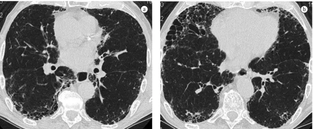 Figura 1 - Exemplo da obtenção do escore de extensão da doença na tomografia computadorizada do tórax de alta  resolução de um homem de 80 anos, portador de fibrose pulmonar idiopática