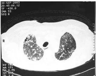 Figura 1 - Tomografia computadorizada de alta resolução  antes da evolução para condensação pulmonar