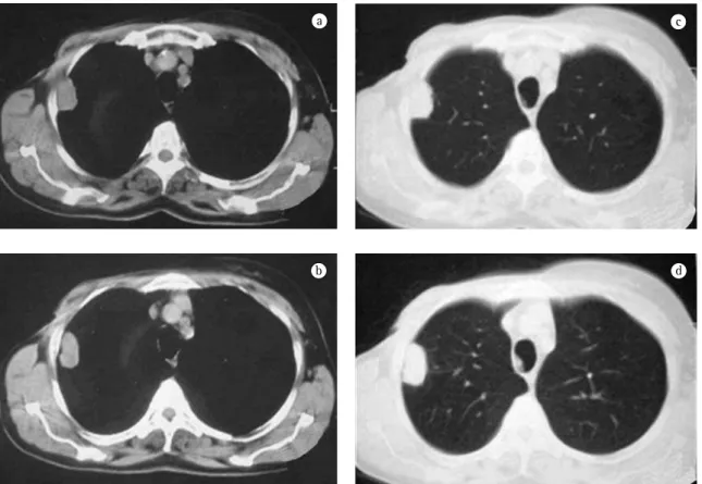Figura  2  -  Tomografia  computadorizada  de  tórax  (a/b:  janela  mediastinal;  c/d:  janela  pulmonar)  evidenciando  lesão pleuro-parenquimatosa, com possível acometimento de parede torácica, de aproximadamente 30  ×  25 mm em  segmento posterior (seg