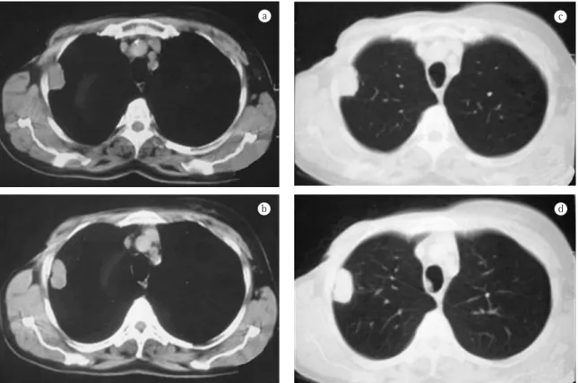 Figure 2 - Computed tomography of the chest (a/b: mediastinal window; c/d: pulmonary window) revealing a pleural,  parenchymal lesion in the posterior segment (segment II) of the upper lobe of the right lung, with possible involvement  of the thoracic wall