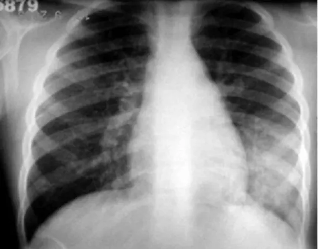 Figure 1 - Chest X-ray revealing diffuse reticular nodular  infiltrates with areas of confluence in the left base.