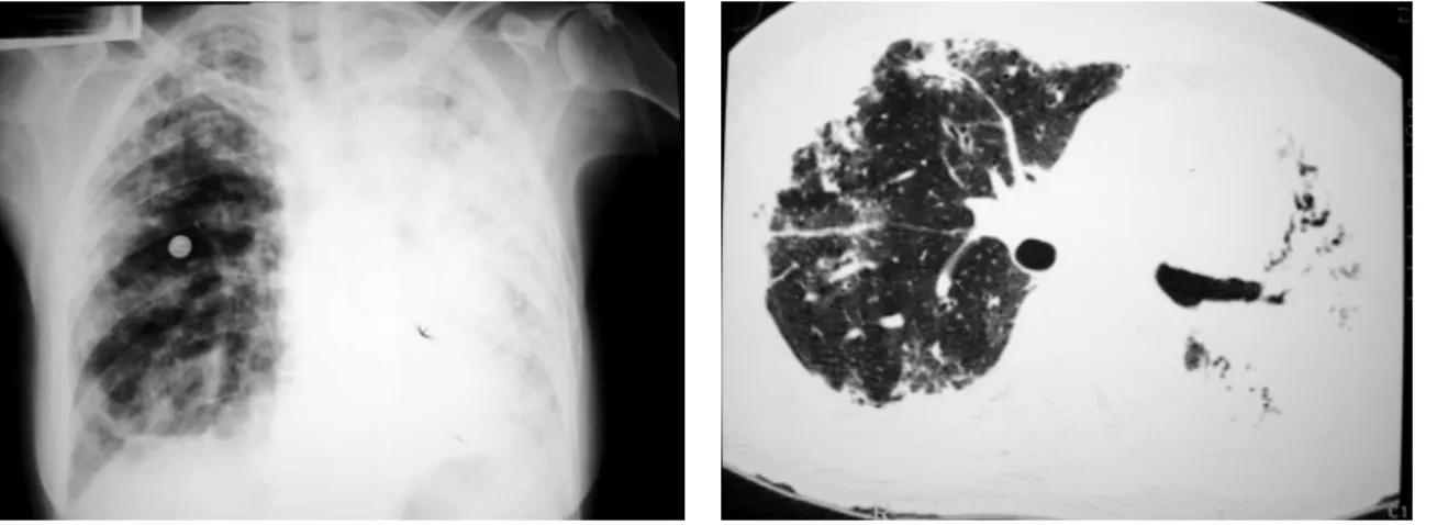 Figure  1  -  Initial  chest  X-ray.  Extensive  areas  of  consolidation, involving the entire left lung and presenting  predominantly peripheral distribution in the right lung.