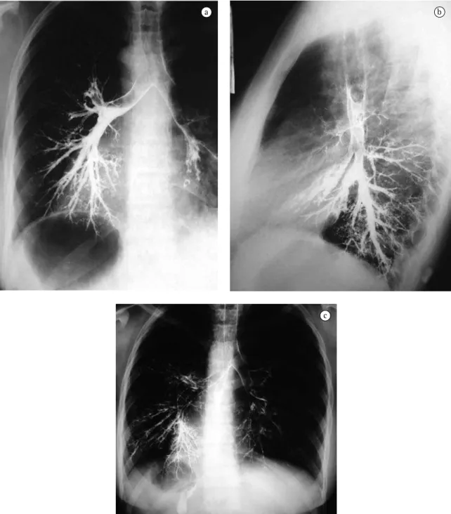 Figura 2 - Broncografias realizadas após administração de contraste iodado nas vias respiratórias