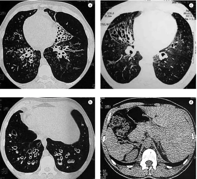 Figura 3 - Tomografia computadorizada de tórax evidenciando numerosas bronquiectasias císticas