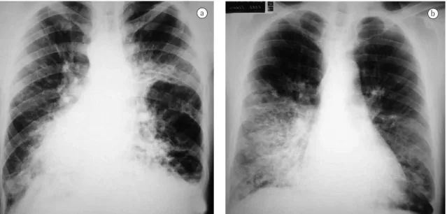 Figure 1 - Chest X-ray with findings suggestive of bronchiectasis: a) dextrocardia (Case 3); and b) cardiac silhouette  displaced to the left (Case 6).