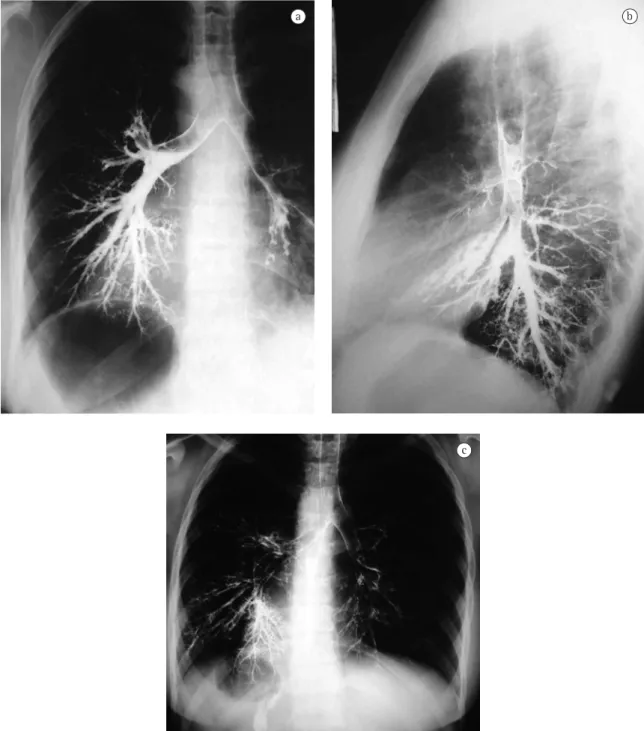Figure 2 - Bronchograms performed after the administration of iodinated contrast medium in the airways: a) and  b)  bronchi  with  increased  diameter  and  lobulated  borders  suggesting  bronchiectasis  (Cases  1  and  3,  respectively); 