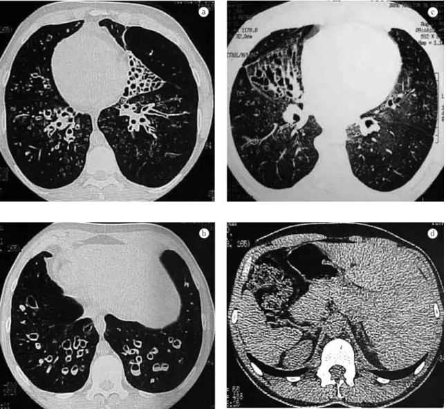 Figure  3  -  Computed  tomography  of  the  chest  revealing  numerous  cystic  bronchiectases  a)  bronchiectasis  with  asymmetric distribution, predominating in the lower lobes and, posteriorly, with zones of atelectasis in the left lower  lobe,  close