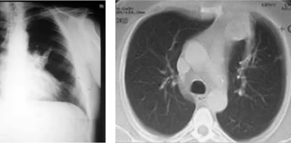 Figure 1 - Chest X-ray. Figure 2 - Computed tomography of the chest.