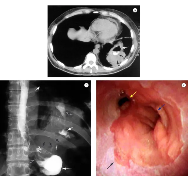 Figura 1 - Caso 1: a) Tomografia axial computadorizada de tórax: abscesso na base do pulmão esquerdo (seta preta  curva) contendo ar (seta branca), e contraste proveniente da bolsa gástrica (seta preta); b) Raio-x contrastado: fístula  a  partir  do  ângul