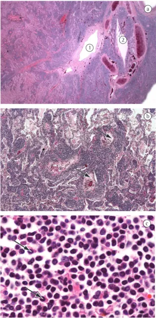 Figure  2  -  Photomicrograph  of  the  lung  lymphoma: 