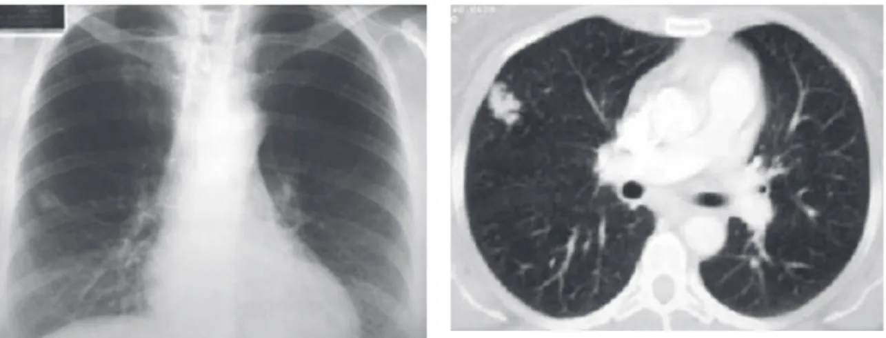 Figura 1 - Radiografia de tórax em posição póstero-anterior. Figura 2 - Tomografia computadorizada.