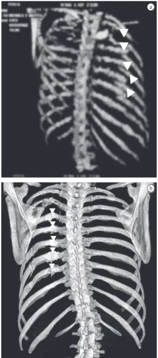 Figura  1  -  Tomografia  computadorizada  de  tórax  mostrando  segmento  de  costela  ‘herniado’  para  a  cavidade, comprimindo pulmão.