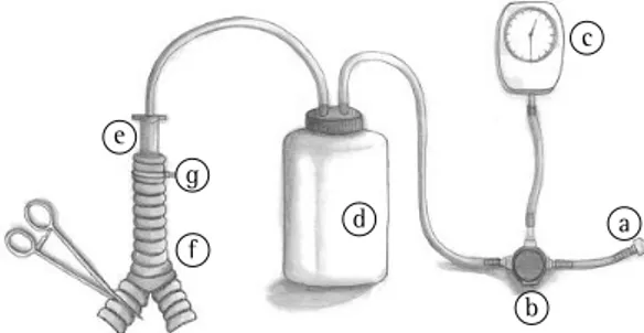 Figura 2 -  Aspecto do coto brônquico esquerdo preparado  para o fechamento com grampeador mecânico.