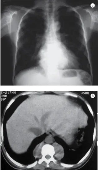 Figura 1 - a) Paciente masculino, 40 anos, com anemia  falciforme.  Radiografia  do  tórax  em  incidência   póstero-anterior,  mostrando  opacidades  lobuladas,  com  limites  parcialmente  bem  definidos,  localizadas  em  topografia  retrocardíaca;  e  