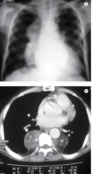 Figura  2  -  a)  Paciente  masculino,  59  anos,  com  esferocitose.  Radiografia  do  tórax  em  incidência  posteroanterior,  demonstrando  volumosas  massas  retrocardíacas,  lobuladas;  e  b)  Paciente  masculino,  59 anos, com esferocitose