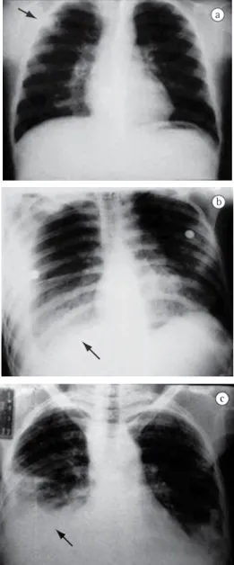 Figura  1  -  Radiografias  de  tórax  selecionadas  dentre  os  casos.  Radiografia  simples  de  tórax  evidenciando: 