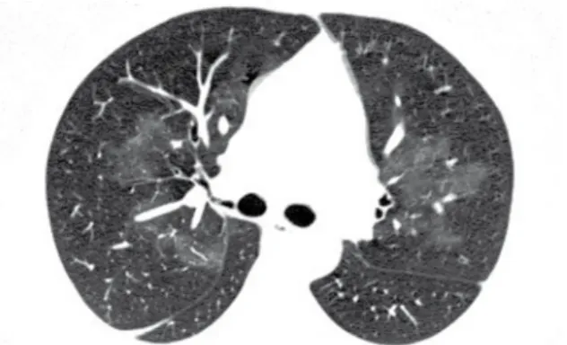 Figura 15 - Opacidade em vidro fosco perihilar simétrica,  representando  hemorragia  pulmonar  em  um  paciente  com granulomatose de Wegener.