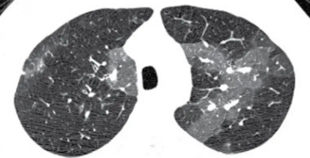 Figura  18  -  Densidade  pulmonar  heterogênea  bem  demarcada. Note o tamanho de vasos menor nas regiões  pulmonares de atenuação baixa