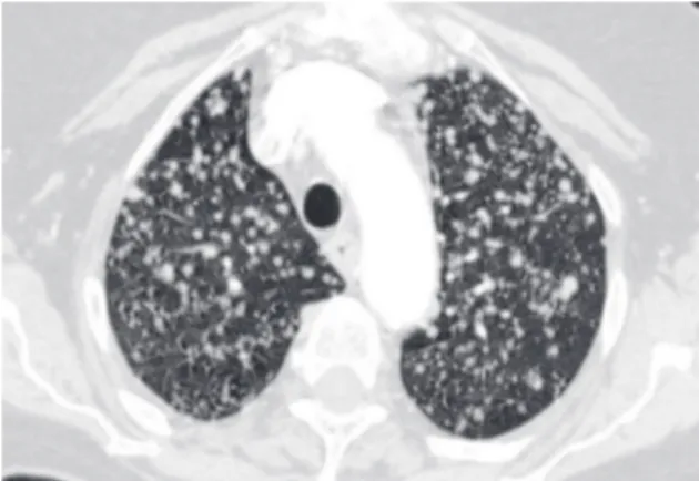 Figure  10  -  Random  nodules  demonstrate  no  specific  relationship  to  the  pulmonary  lobule