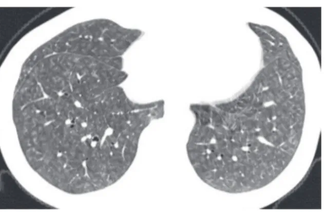 Figure  11  -  High-resolution  computed  tomography  scan  showing  centrilobular  nodules  of  ground-glass  attenuation