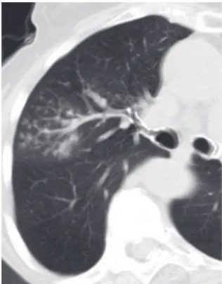 Figure  14  -  Acute  infectious  bronchiolitis.  Acute  and  chronic  inflammation  involving  terminal  airway  walls,  with  variable  endobronchial  exudates,  characterizes  infectious  bronchiolitis