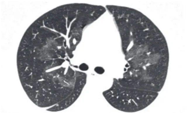Figure  15  -  Symmetric  perihilar  ground-glass  opacity,  representing  pulmonary  hemorrhage  in  a  patient  with  Wegener’s granulomatosis.