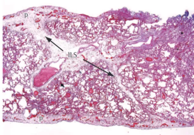 Figure 1 - Interlobular septal thickening in a patient with  pulmonary  edema.  Note  the  thin,  interconnecting  lines  forming  polygonal  shaped  structures