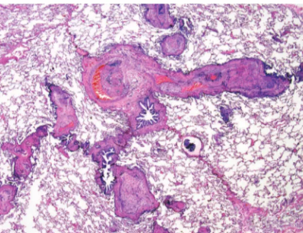 Figure 4 - Sarcoidosis. Extensive lymphatic granulomas  of  sarcoidosis  can  be  seen  in  this  photomicrograph