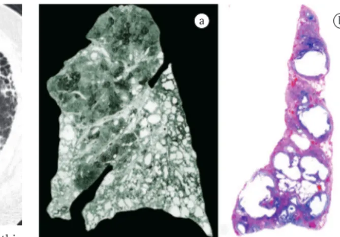 Figure 8 - Usual interstitial pneumonia. Irregular septal  fibrosis,  with  relative  centrilobular  sparing,  can  be  seen  in this photomicrograph