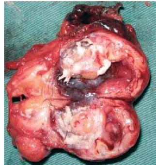 Figure  1  -  Tomography  scan  of  the  chest  (mediastinal  window).