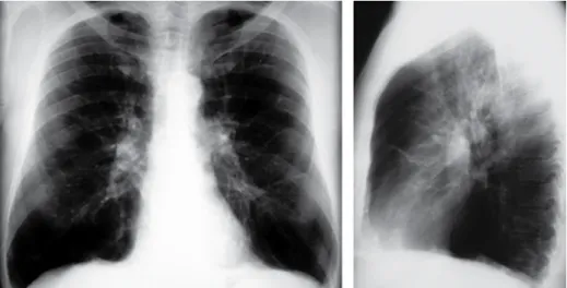 Figura  1  - Radiografia simples de tórax (em póstero-anterior e perfil) de paciente portador de enfisema pulmonar  secundário à deficiência de alfa-1 antitripsina