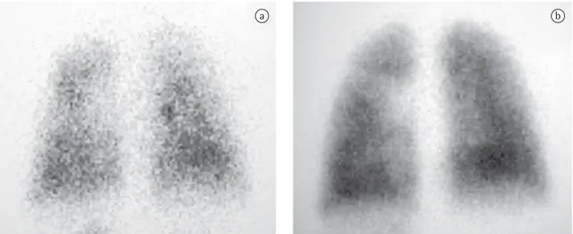 Figura 1 - Mapeamento de inalação (a) e perfusão (b) pulmonar (visão posterior) evidenciando captação homogênea  e concordante do radiofármaco.