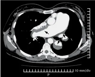 Figura 2 - Angiotomografia de tórax (2004) ao nível do  tronco  da  artéria  pulmonar  evidenciando  dilatação  das  artérias brônquicas e trombos parietais excêntricos até os  ramos segmentares (setas pretas).