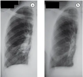 Figura 1 - Paciente 4: a) radiografia de tórax revelando  aneurisma  de  artéria  pulmonar;  b)  radiografia  de  tórax  mostrando  resolução  de  aneurisma  de  artéria  pulmonar  depois do tratamento imunossupressivo.