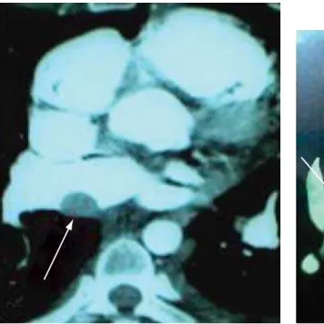 Figure 1 - Thrombus in the pulmonary artery. Figure 2 - Thrombus in the right atrium.