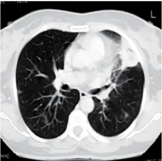 Figura  1  -  Tomografia  computadorizada  de  tórax  pré-tratamento mostrando uma massa heterogênea de 4  cm com continuidade pleural ao nível da língula e dois  micronódulos  na  região  posterior  do  campo  pulmonar  direito.