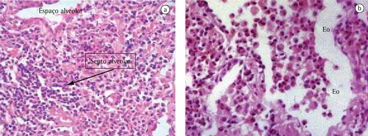 Figura 1 - Pneumonia eosinofílica crônica: a) detalhe do espessamento septal alveolar (seta) por eosinófilos e células  mononucleares, H &amp; E 200×; e b) infiltrado de eosinófilos (Eo) ao longo dos septos alveolares e interior dos espaços  alveolares, H&