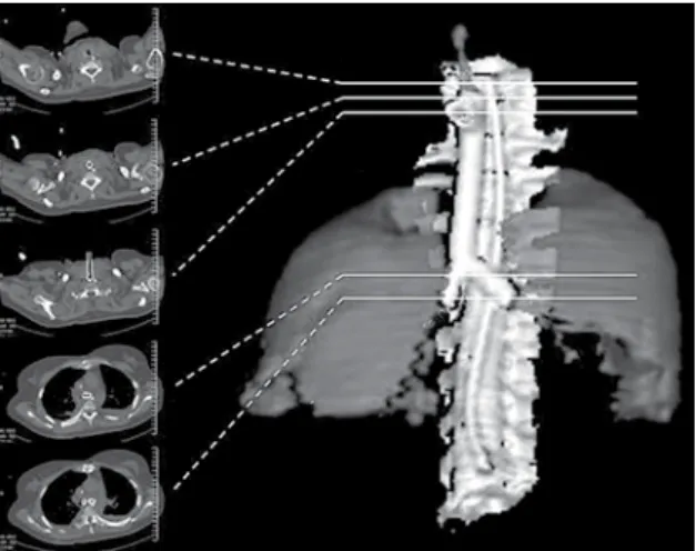 Figura 3 - TC de tórax pós-operatória: TC de tórax em  plano axial e reconstrução tridimensional evidenciando a  prótese traqueobrônquica já posicionada.