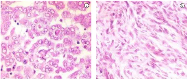 Figure 1 - a) Malignant epithelial mesothelioma (hematoxylin-eosin, ×200, malignant mesothelial cells in detail with  discrete  anaplasia;  and  b)  Malignant  sarcomatoid  mesothelioma  (hematoxylin-eosin,  ×200,  note  the  spindle  cells  densely groupe
