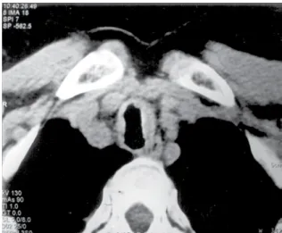 Figure  1  -  Tracheobronchial  amyloidosis.  Mediastinal  window slice showing diffuse nodular thickening of the  tracheal wall.