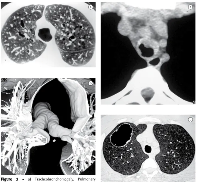 Figure 4 - a) Tracheobronchial papillomatosis. Mediastinal  window slice revealing irregular thickening of the tracheal  wall, with nodules and plaques protruding into the lumen; 