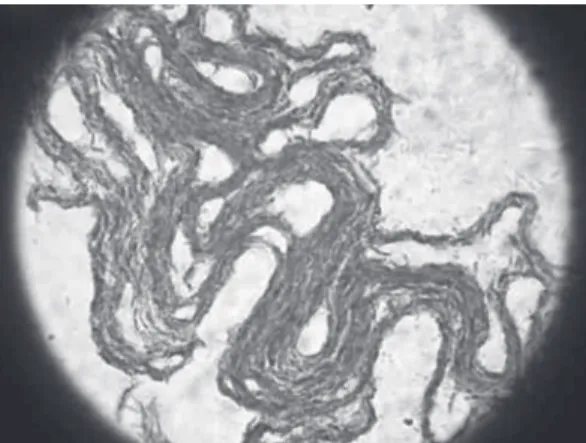 Figure  1  -  Photomicrograph  demonstrating  cord  formation (Ziehl-Neelsen staining).