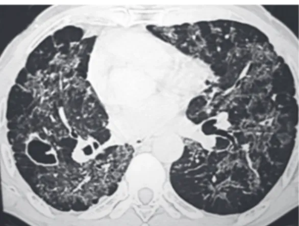 Figure  2  -  HRCT  scan  of  the  chest.  Ground-glass  opacities, tree-in-bud pattern, cavity, bronchiectasis,  peribronchovascular thickening, centrilobular nodules  and subpleural nodules.