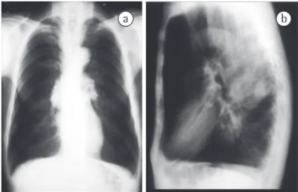 Figure  2  -  Anterior  (a)  and  lateral  (b)  chest  X-rays  showing  a  spherical  mass  of  5  cm  in  diameter
