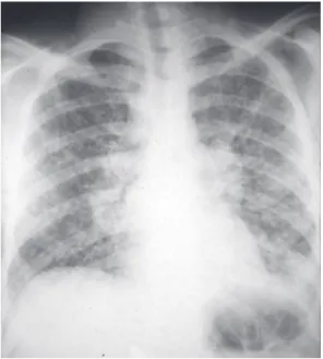 Figure  1  -  Anteroposterior  chest  X-ray  showing  diffuse micronodular infiltrate with bilateral and right  paratracheal hilar lymph node enlargement