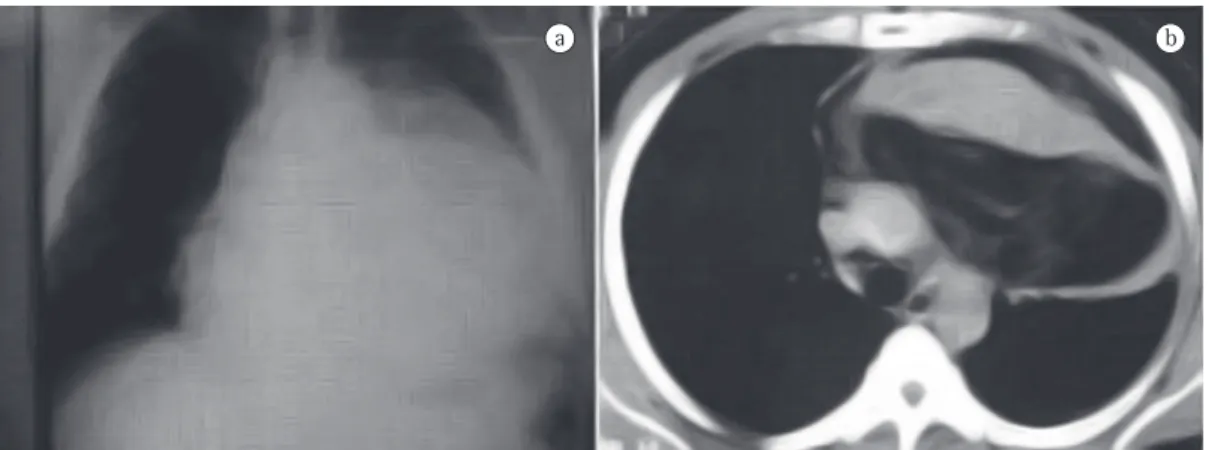 Figura 1 - a) Radiografia de tórax revelando opacidade no mediastino e no hemitórax esquerdo, lembrando  cardiomegalia