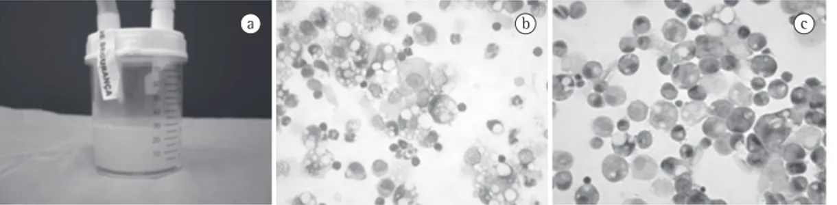 Figure 1 - Macroscopic and microscopic aspect of the bronchoalveolar lavage fluid. In a), opalescent fluid  with supernatant halo of fat; in b), numerous foamy macrophages with intracytoplasmic lipid vacuoles stained  with Giemsa; in c), foamy macrophages 