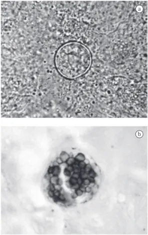 Figura  1  -  a)  exame  microscópico  de  escarro  em  preparação  com  hidróxido  de  potássio  a  10%,  demonstrando a fase parasitária do fungo, representada  por  esférula  repleta  de  endósporos;  b)  forma  parasitária do  Coccidioides immitis  car