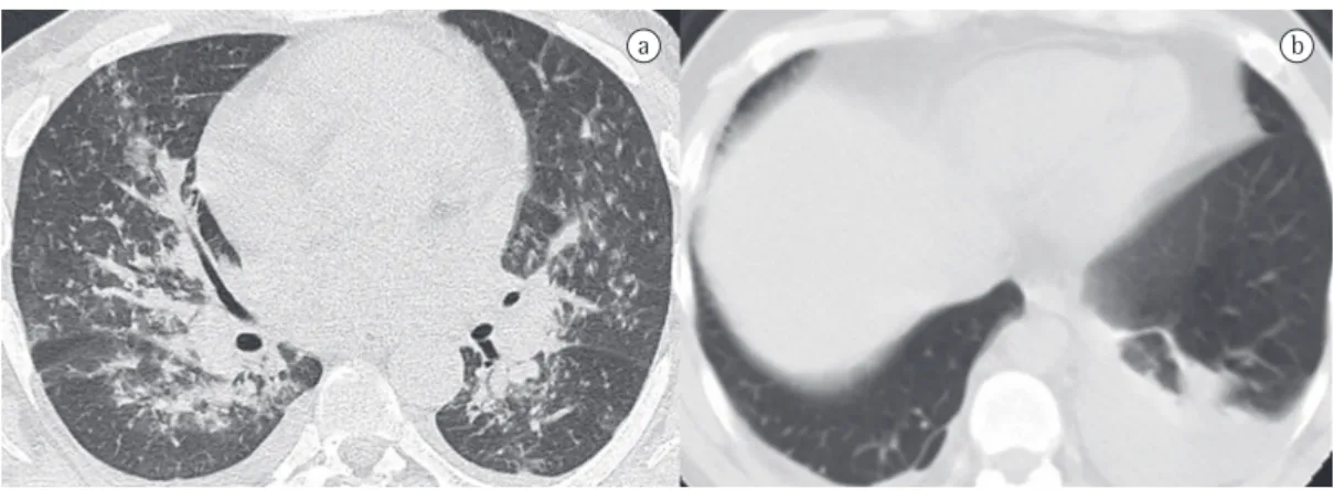 Figure 1). The halo sign was observed in three of  the five cases of nodules (67%; Figure 2).