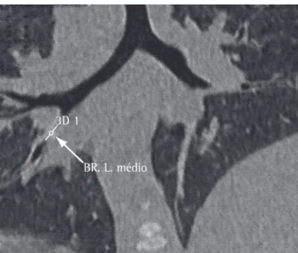 Figure  1  -  CT  scan  of  the  chest  in  a  patient  with  suspected  FBA.  Organic  foreign  body  in  topography  of middle lobe (arrow).